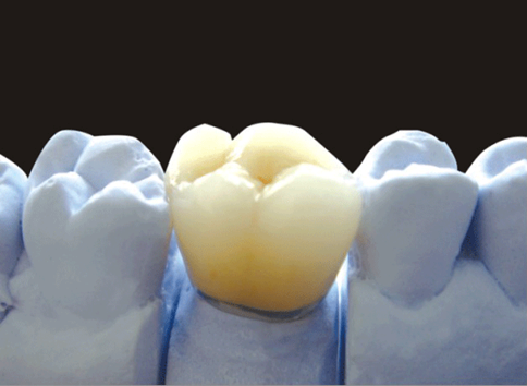 All-ceramic restoration product image 1