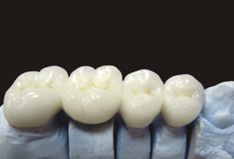 All-ceramic restoration product image 2