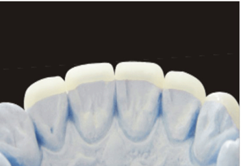 All-ceramic restoration product image 3