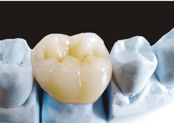 All-ceramic restoration product image 4
