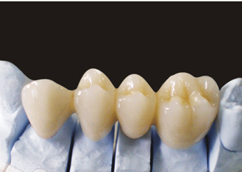 All-ceramic restoration product image 5