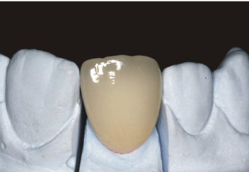 All-ceramic restoration product image 6
