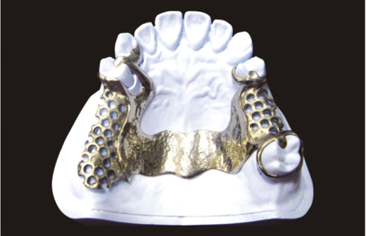 Cast partial framework product image 2