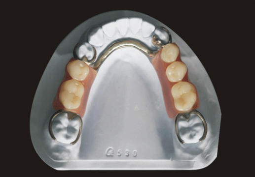 Cast partial framework product image 3