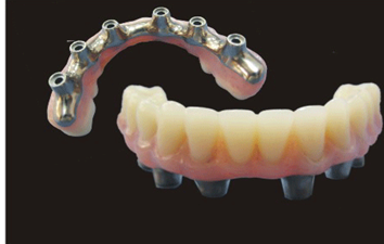 Implant restoration product image 1