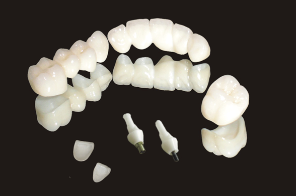 Implant restoration product image 2