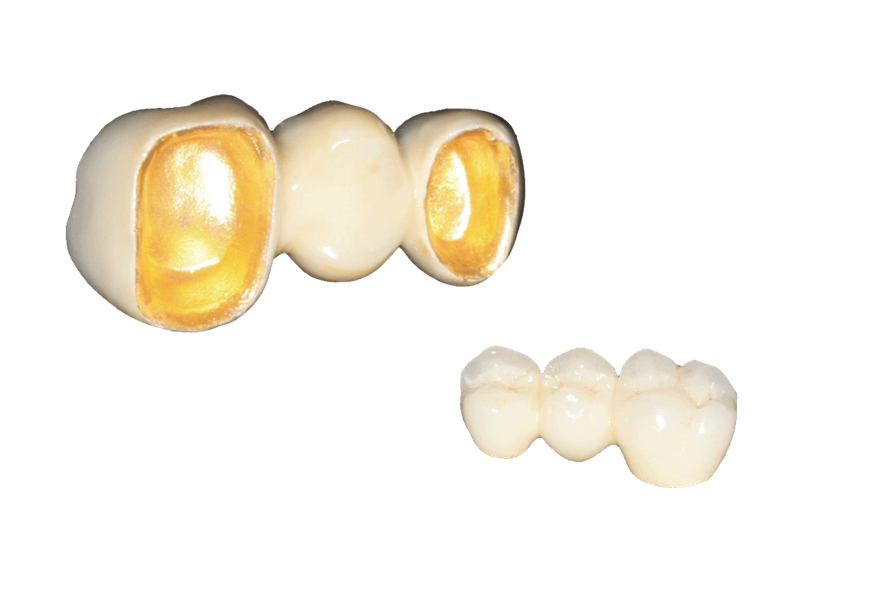 Porcelain fused to metal product image 1
