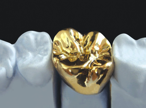 Porcelain fused to metal product image 2
