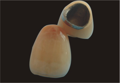 Porcelain fused to metal product image 3