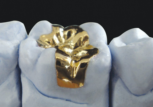 Porcelain fused to metal product image 4